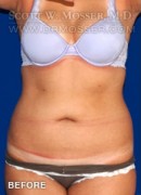 Liposuction - Abdomen & Flanks Patient 79590 Before Photo Thumbnail # 1