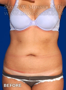 Liposuction - Abdomen & Flanks Patient 79590 Before Photo # 1
