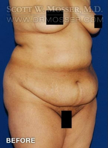 Liposuction - Abdomen & Flanks Patient 51266 Before Photo # 5
