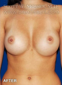 Breast Augmentation Patient 24873 After Photo # 2