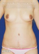 Abdominoplasty Patient 90960 After Photo Thumbnail # 2