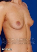 Breast Augmentation Patient 87318 Before Photo Thumbnail # 3