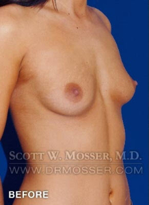 Breast Augmentation Patient 87318 Before Photo # 3