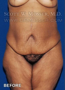 Lower Body Lift Patient 16603 Before Photo # 1