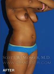 Liposuction - Abdomen & Flanks Patient 11942 After Photo # 4