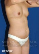 Liposuction - Abdomen & Flanks Patient 98943 Before Photo Thumbnail # 3