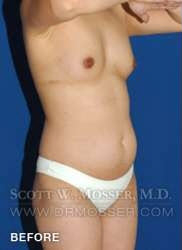 Liposuction - Abdomen & Flanks Patient 98943 Before Photo # 3