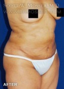 Liposuction - Abdomen & Flanks Patient 51266 After Photo Thumbnail # 6