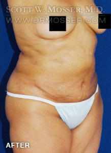 Liposuction - Abdomen & Flanks Patient 51266 After Photo # 6