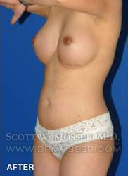 Liposuction - Abdomen & Flanks Patient 98943 After Photo # 6