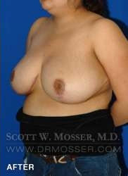 Breast Reduction Patient 27332 After Photo # 4