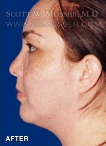 Chin Implant Patient 69285 After Photo # 6