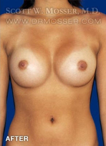 Breast Augmentation Patient 85660 After Photo # 2
