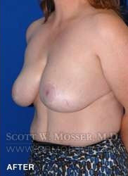 Breast Reduction Patient 97519 After Photo # 4