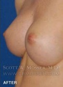Nipple Inversion Correction Patient 70533 After Photo Thumbnail # 4