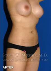 Liposuction - Abdomen & Flanks Patient 58519 After Photo # 4