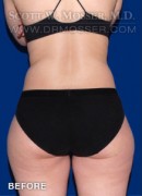 Liposuction - Thighs Patient 97167 Before Photo Thumbnail # 1