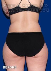 Liposuction - Thighs Patient 97167 Before Photo # 1