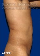 Liposuction - Chest Patient 51091 After Photo Thumbnail # 8