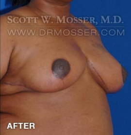 Breast Reduction Patient 91361 After Photo # 4