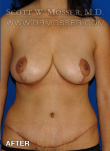 Breast Reduction Patient 58437 After Photo # 2