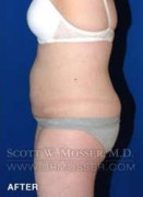 Liposuction - Abdomen & Flanks Patient 26351 After Photo Thumbnail # 8