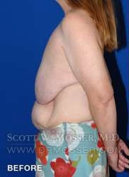 Breast Reduction Patient 97519 Before Photo # 9