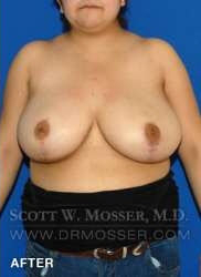 Breast Reduction Patient 27332 After Photo # 10