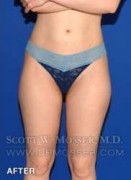 Liposuction - Thighs Patient 68368 After Photo Thumbnail # 2