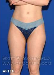 Liposuction - Thighs Patient 68368 After Photo # 2