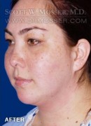 Chin Implant Patient 69285 After Photo Thumbnail # 4