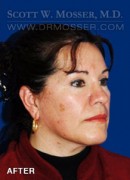Upper Blepharoplasty Patient 92612 After Photo Thumbnail # 4