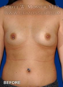 Breast Augmentation Patient 59926 Before Photo # 1