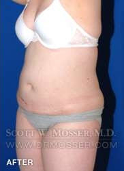 Liposuction - Abdomen & Flanks Patient 26351 After Photo # 10