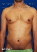 Liposuction - Chest Patient
