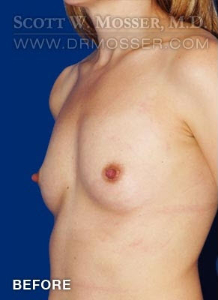 Breast Augmentation Patient 10196 Before Photo # 3
