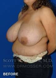 Breast Reduction Patient 27332 Before Photo # 3