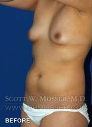 Liposuction - Abdomen & Flanks Patient 58519 Before Photo # 5