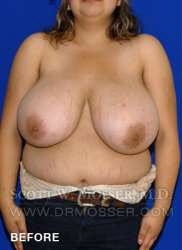 Breast Reduction Patient 27332 Before Photo # 9