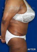Abdominoplasty Patient 30014 After Photo Thumbnail # 6