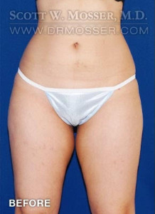 Liposuction - Abdomen & Flanks Patient 82898 Before Photo # 1
