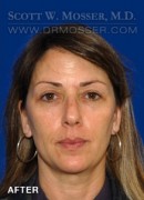 Upper Blepharoplasty Patient 94858 After Photo Thumbnail # 2