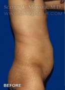 Liposuction - Abdomen & Flanks Patient 52450 Before Photo Thumbnail # 5