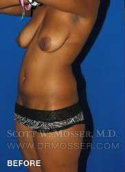 Liposuction - Abdomen & Flanks Patient 11942 Before Photo # 5