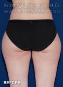 Liposuction - Thighs Patient 40477 Before Photo Thumbnail # 3