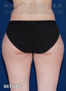 Liposuction - Thighs Patient 40477 Before Photo # 3