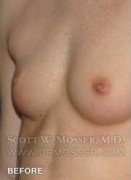 Nipple Inversion Correction Patient 70533 Before Photo Thumbnail # 3