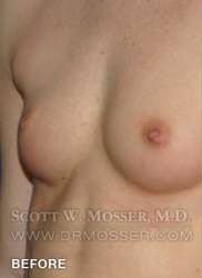 Nipple Inversion Correction Patient 70533 Before Photo # 3