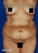 Liposuction - Abdomen & Flanks Patient 51266 Before Photo Thumbnail # 1