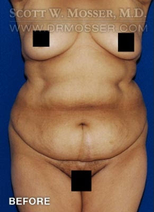 Liposuction - Abdomen & Flanks Patient 51266 Before Photo # 1
